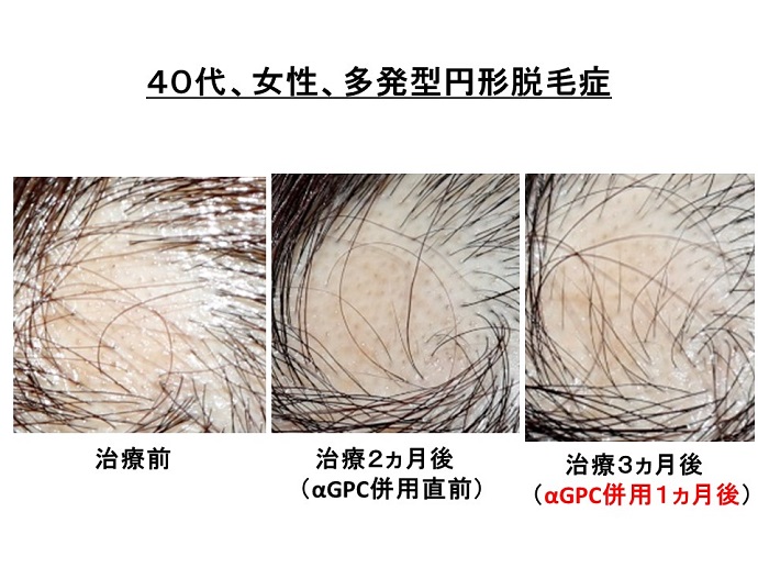 円形脱毛症　病院